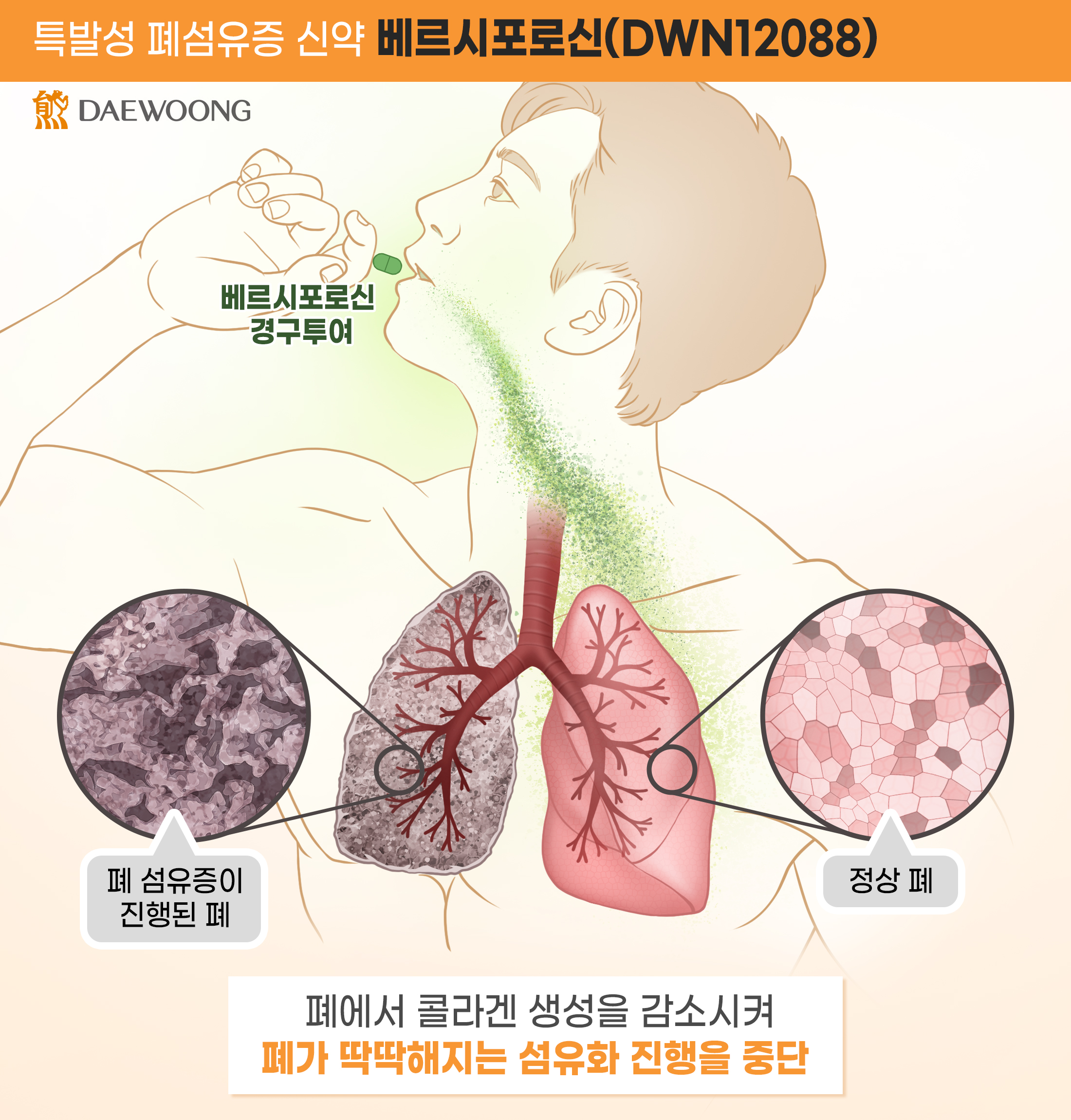 대웅제약 '베르시포로신' 미국 이어 유럽서 희귀의약품 지정